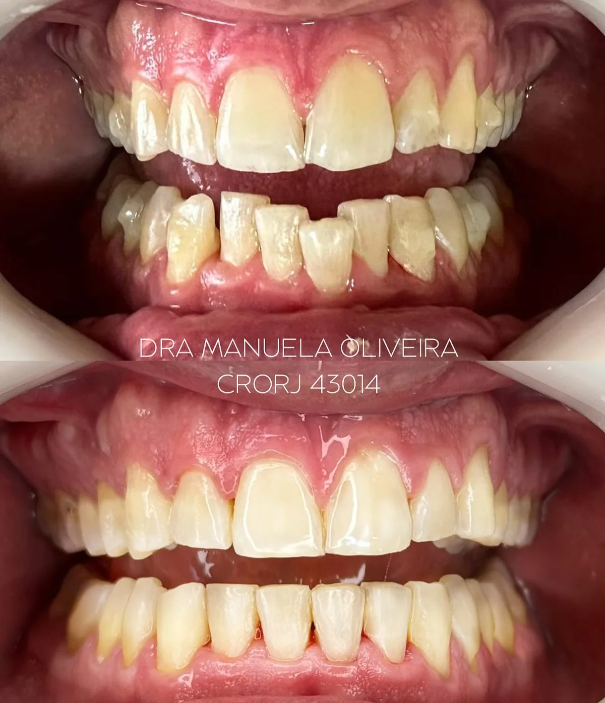 Antes e depois de ortodontia, paciente da Dra. Manuela Oliveira