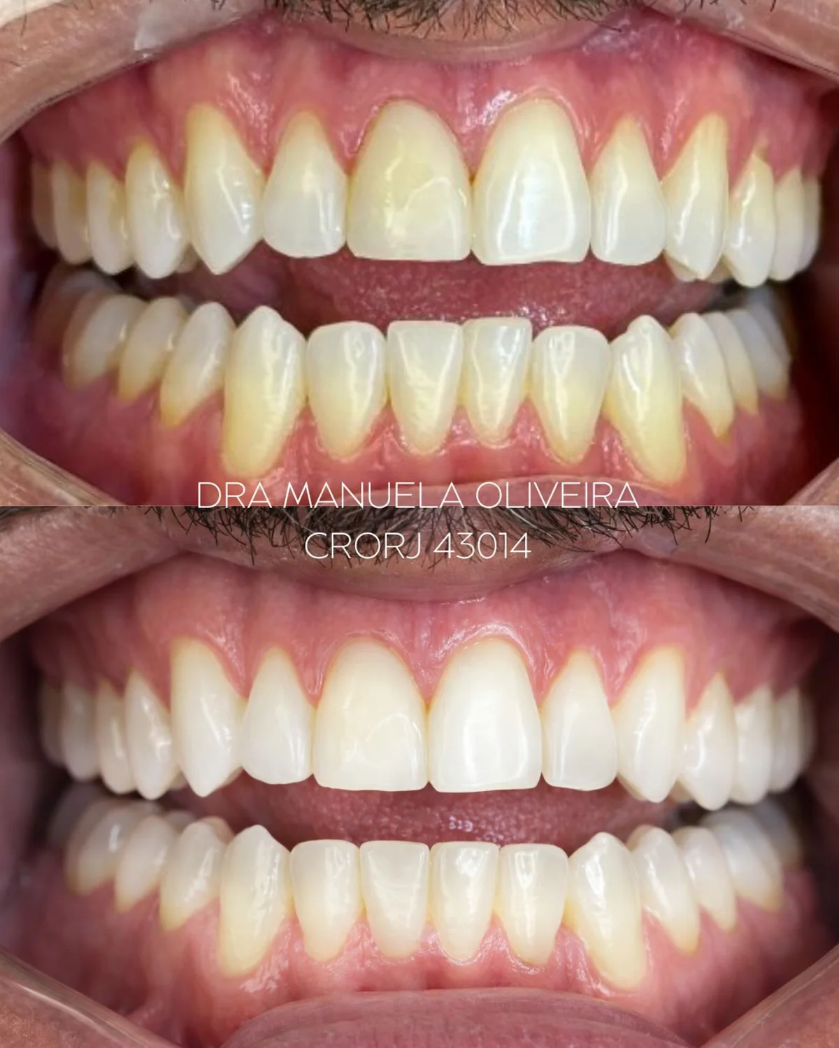 Antes e depois de clareamento dental, paciente da Dra. Manuela Oliveira
