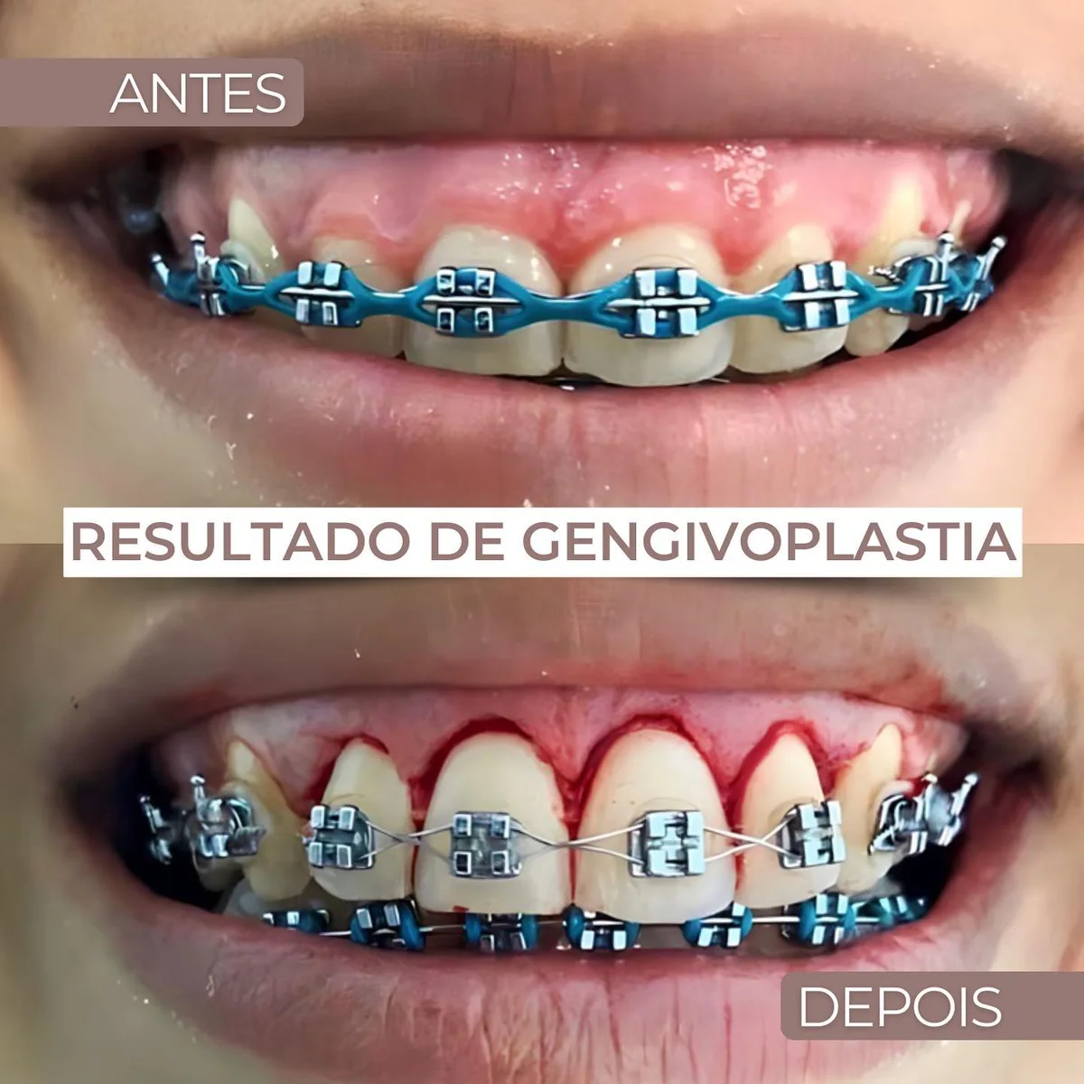 Antes e depois de gengivoplastia, paciente da Dra. Manuela Oliveira