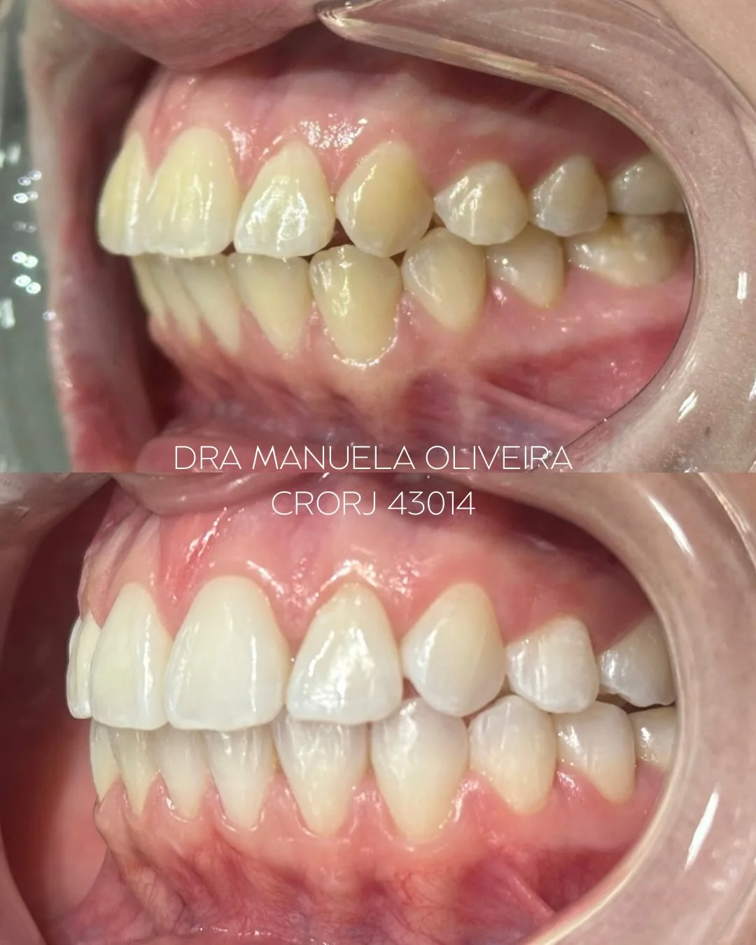 Antes e depois de ortodontia, paciente da Dra. Manuela Oliveira